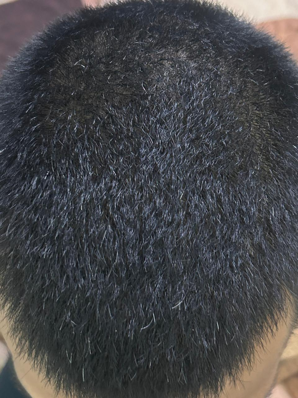 After hair growth treatment