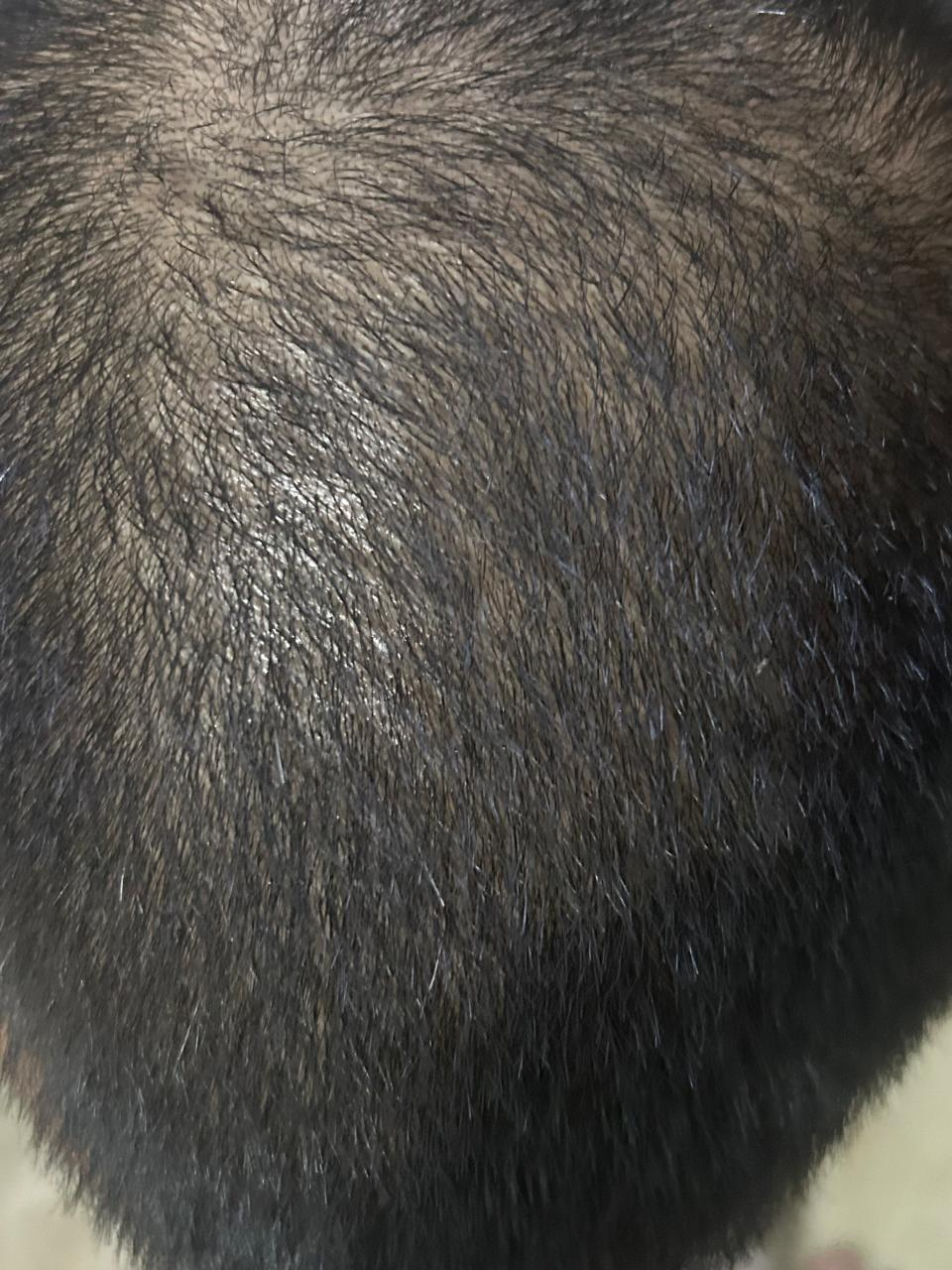 Before hair growth treatment